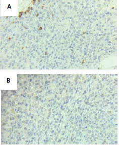 Tinción IHQ con marcadores estudiados negativos. 6a) Microfotografía 40x. CD3 (-); 6b). Microfotografía 40x. CD30 (-). (Figura 6) 